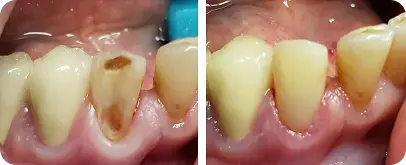 Before and after dental treatment showing tooth decay restored with a filling