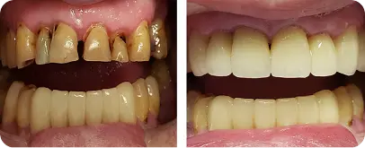 Before and after dental restoration showing damaged teeth replaced with porcelain crowns or veneers