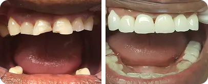 Before and after smile makeover showing gaps and uneven teeth restored with dental veneers or crowns