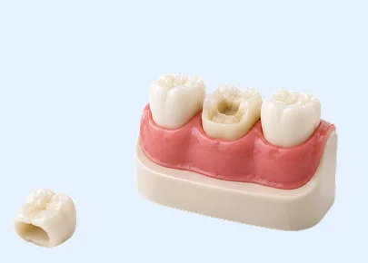 Dental crown restoration model demonstrating crown treatment