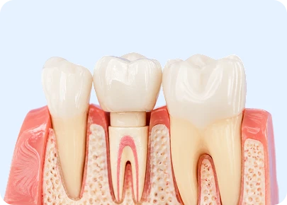 Anatomical dental model showing a tooth crown being placed over a prepared tooth with surrounding gum and bone structure