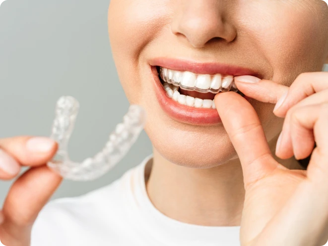 Woman placing a clear dental aligner over her teeth while holding another tray